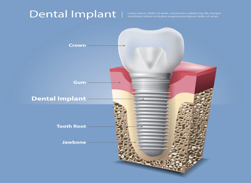 Dental Implants Dental Implants