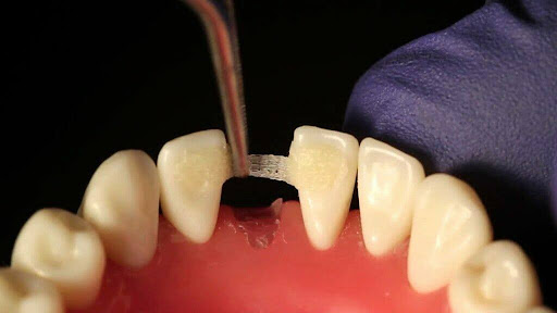 Fibre Reinforced Composite (FRC) Fibre Reinforced Composite (FRC)
