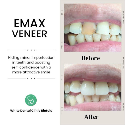 Teeth Whitening Teeth Whitening