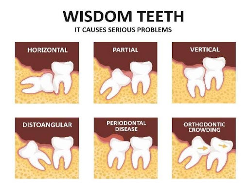 Why are wisdom tooth removed?
