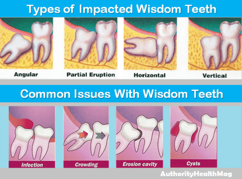 Why are wisdom tooth removed?